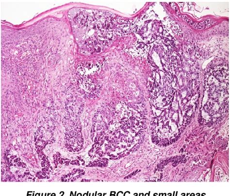 Figure 2 From A Rare Case Of Neglected Giant Basal Cell Carcinoma In A