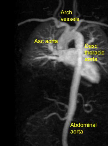 MR Aortogram – All About Cardiovascular System and Disorders