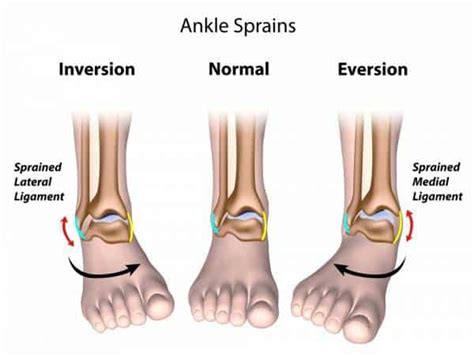 Ouch...I just hurt my ankle. Is it broken or just a sprain?