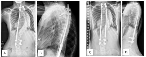 Radiographs Of Patient 23 With Idiopathic Early Onset Scoliosis