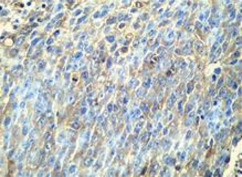 Immunohistochemical staining result for IHS of HIF 1α in the four