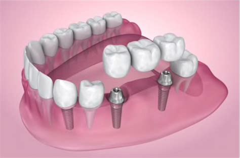 Reabilitação oral Clermont Odontologia