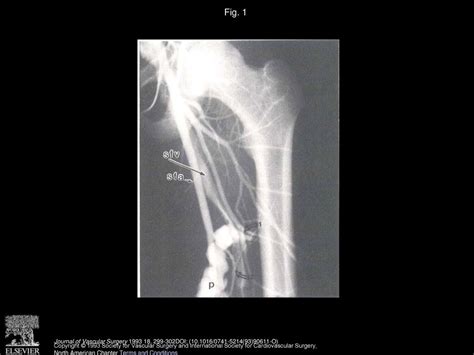 Percutaneous Transfemoral Insertion Of A Stented Graft To Repair A