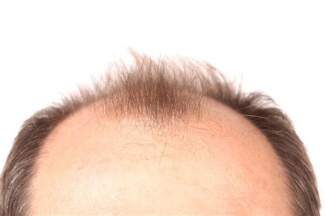 Understanding Male Pattern Baldness Expert Insights