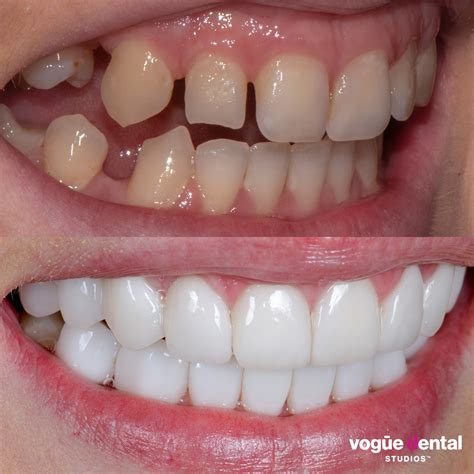 Picasso Porcelain Veneers Before And After Rebekah L Vogue Dental