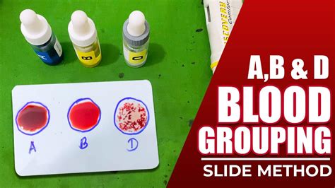 Procedure For Determination Of Blood Group Blood Group Determination