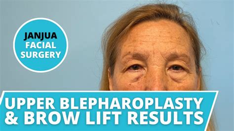 Upper Blepharoplasty And Brow Lift Before And After 3 Months Post Op Dr