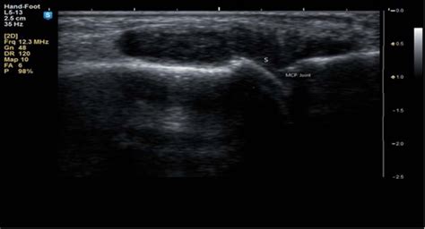 Gray Scale Us Long Axis View Of Mcp Joint Of Right Index Finger Of The Download Scientific