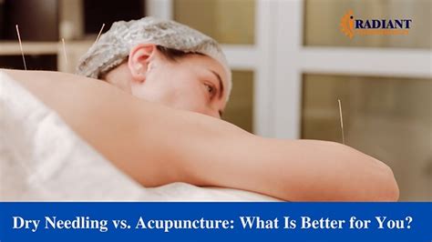 Radiant Physiotherapy Clinic Dry Needling Vs Acupuncture What Is