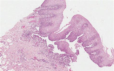 Acrochordon Histology