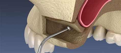 Elevación de Seno Maxilar Una Solución Clave para la Colocación de