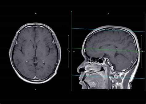 Gadolinium Mri