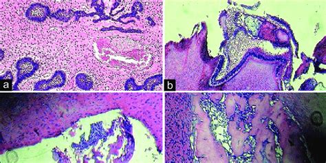 A Photomicrograph Showing Islands And Strands Of Odontogenic