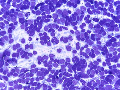 Nephroblastoma Wilms Tumour Eurocytology