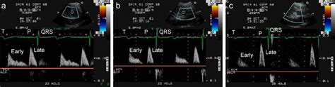 Pulse Wave Doppler Images Showing Biphasic Ventricular Filling Pattern