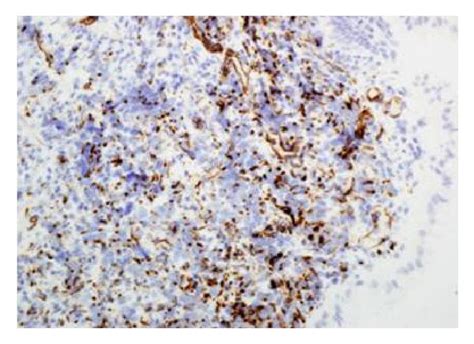 Desmoplastic Small Round Cell Tumor Dsrct Of The Resected Gastric