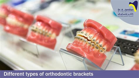 Different Types of Orthodontic Brackets - Dr Jamilian