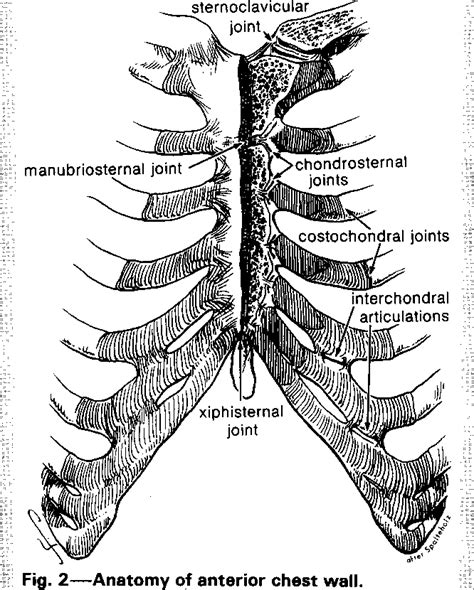 Xiphisternum Pain | informacionpublica.svet.gob.gt