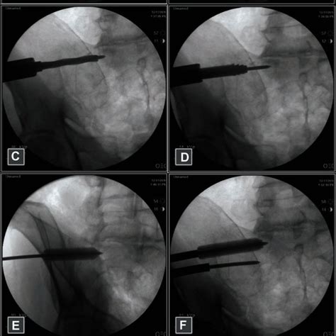 Postoperative Radiograph Demonstrating Three Ifuse Implants In A Female