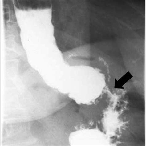 Stenosed vertical banded gastroplasty as seen on... | Download ...