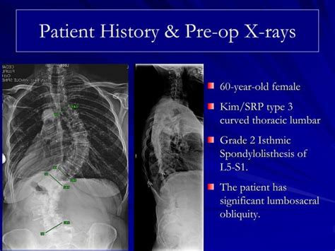 Case Review 31 60 Year Old Female With Adult Idiopathic Scoliosis Ppt