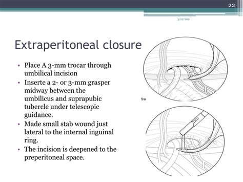 Inguinal Hernias In Pediatrics