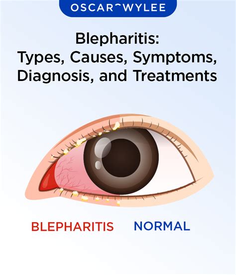 Blepharitis Types Causes Symptoms Diagnosis And Treatments