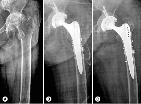 A This Patient Suffered From Left Hip Pain Associated With Rheumatoid Download Scientific