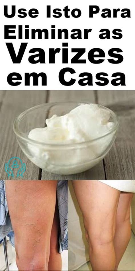 Receita Natural Para Remover Varizes Das Pernas Passo A Passo