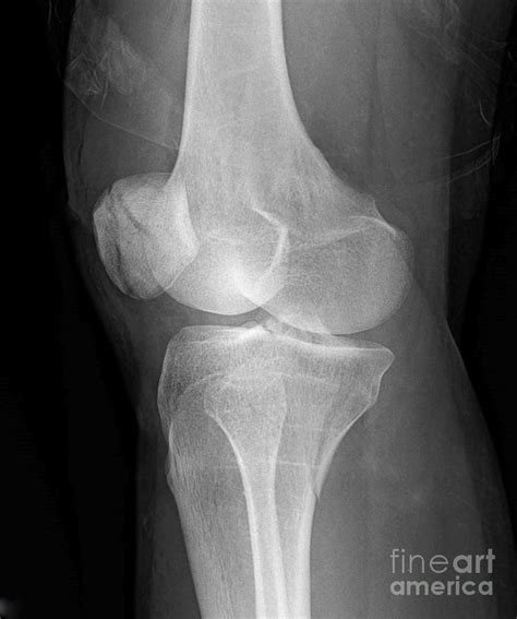 Broken Knee Cap #3 by Rajaaisya/science Photo Library