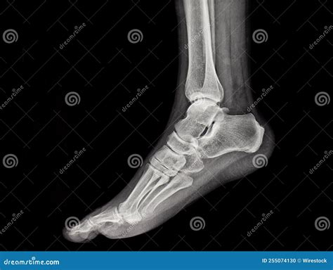 An X-ray of the Human Foot and Ankle Stock Photo - Image of anatomy, diagnosis: 255074130