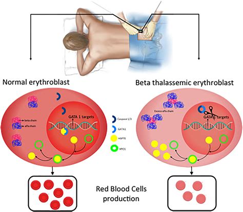 Frontiers New Insights Into Pathophysiology Of Thalassemia