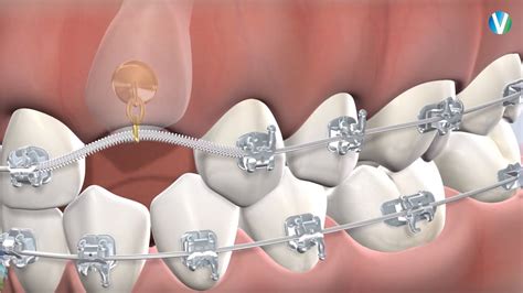 Expose And Bond In Ventura Ca Greater Ventura Oral Facial Surgery