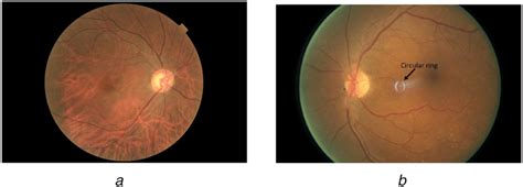 Samples Of Fundus Images With Red Colour Leopard Print And Circular