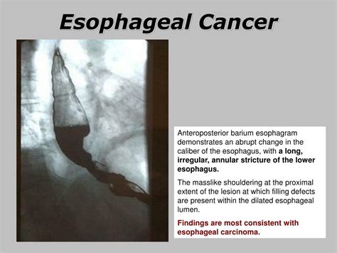 Ppt Esophageal Cancer Powerpoint Presentation Free Download Id6708684