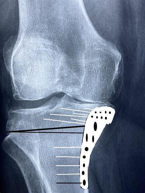 High Tibial Osteotomy - Orthopedics Notes