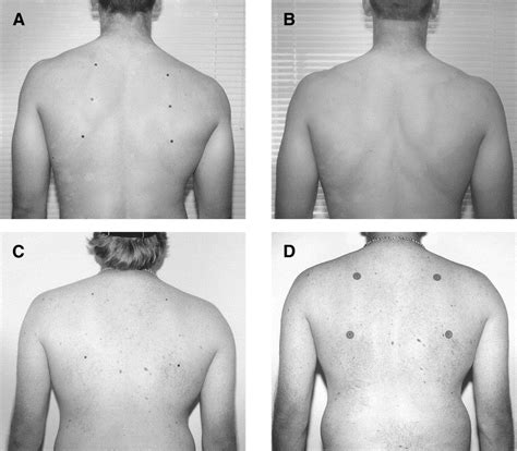 The Disabled Throwing Shoulder Spectrum Of Pathology Part Iii The