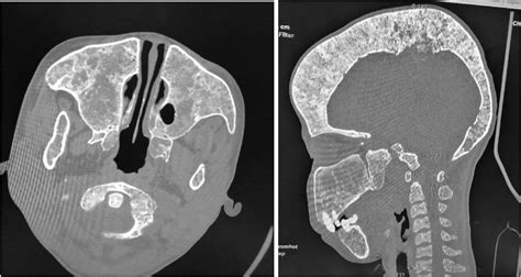 Imaging Of Advanced Craniofacial Fibrous Dysplasia Associated With