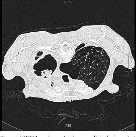 Figure 1 from Chronic cavitary pulmonary aspergillosis | Semantic Scholar