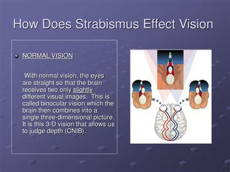 Ppt Strabismus Powerpoint Presentation Free Download Id 3993393