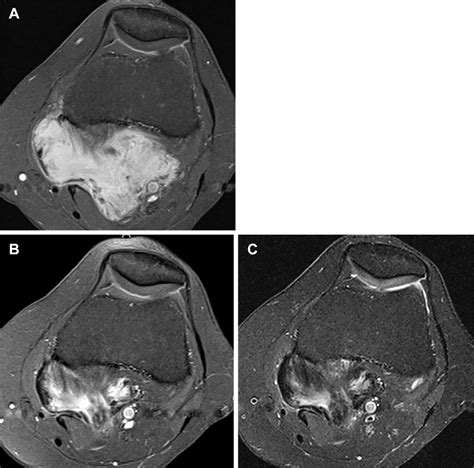 MRI Volumetrics And Image Texture Analysis In Assessing Systemic