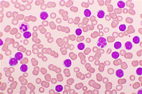 Acute Lymphoblastic Leukemia Histology - Rare Disease Advisor