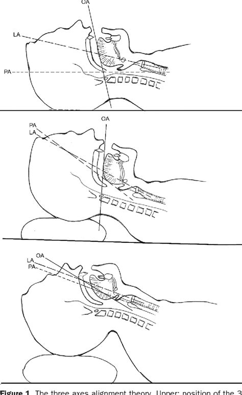 Figure 1 From Head And Neck Position For Direct Laryngoscopy Semantic Scholar