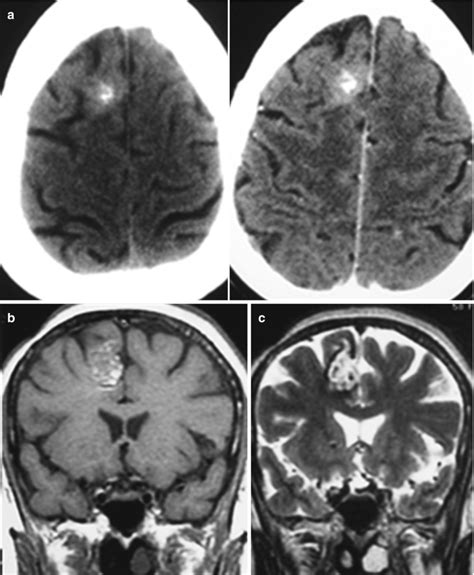 Fig 56 Cavernoma Axial Ct Images A Diseases Of The Brain Head And Neck Spine