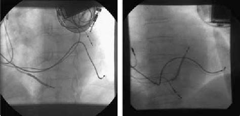 Figure 1 From Initial 100 Patient Experience Of Transseptal Puncture