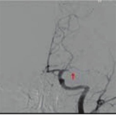 Cerebral Angiogram Of The Patient Showing Occlusion Of Right Middle