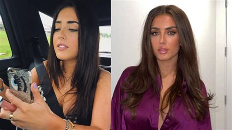 Sumner Strohs Plastic Surgery The Ig Model Has Her Lips And Cheeks Done