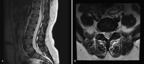 Sagittal And Axial T2 Weighted Lumbar Spine Magnetic Resonance Imaging Download Scientific