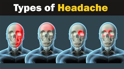 Headache - Types and causes | 3d Animation - YouTube