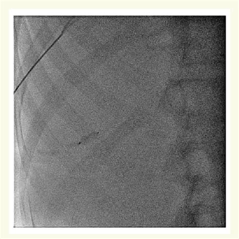 Closure Of Transhepatic Access Fluoroscopic Image Of Vascular Plug